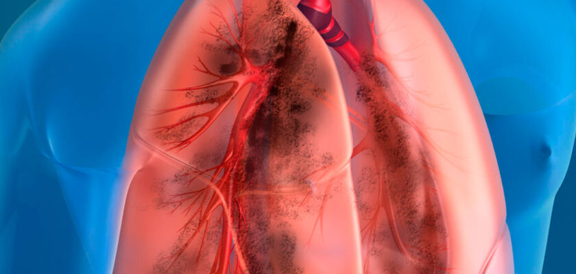 Tuberculosis por PCR